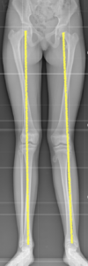 Ginocchio valgo in esostosi tibia