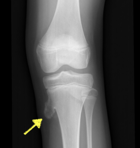radiografia esostosi tibia