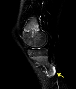 risonanza magnetica esostosi tibia