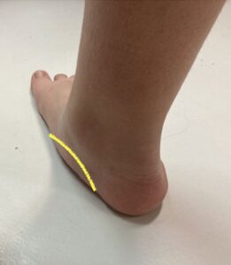 riduzione volta plantare piede piatto