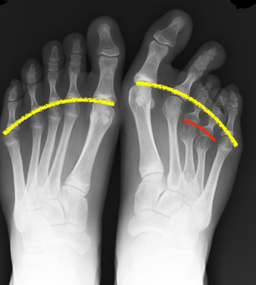 radiografia brachimetatarsia