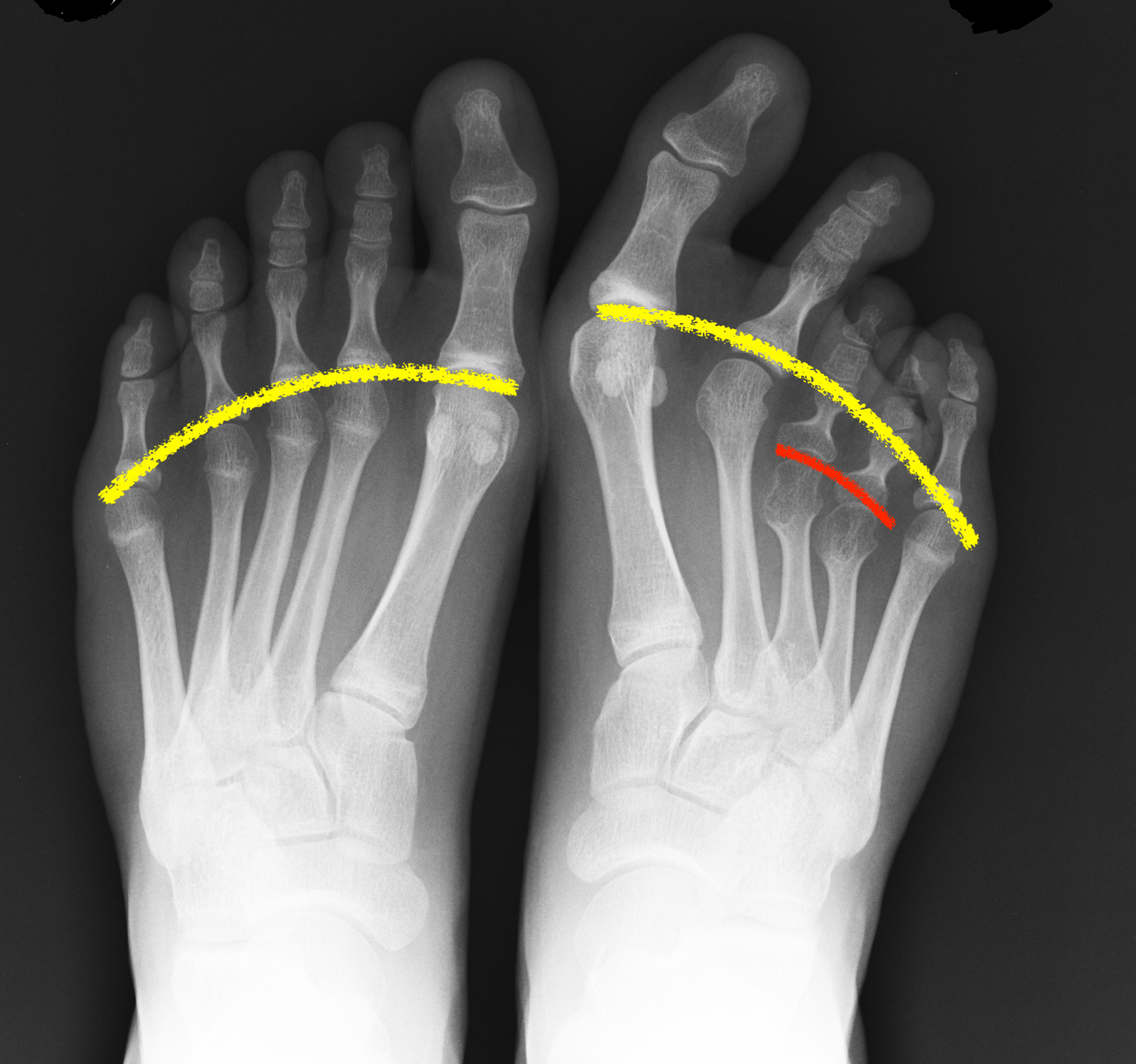 radiografia brachimetatarsia