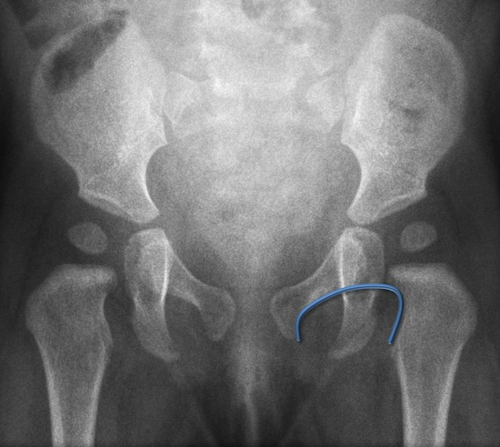 radiografia bacino arco di shenton