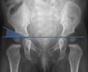 radiografia bacino indice acatabolare
