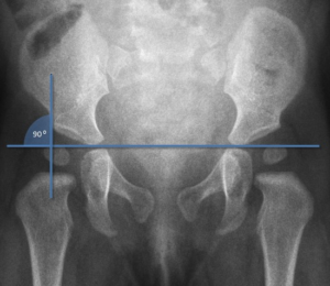 radiografia bacino displasia dell'anca