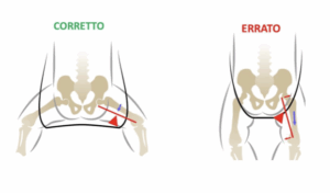 displasia anche neonato