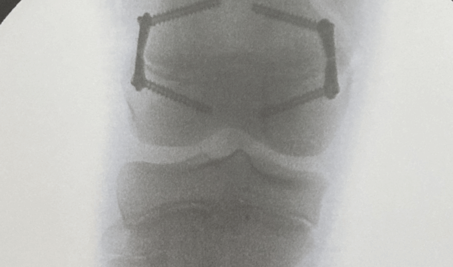 epifisiodesi simmetrica