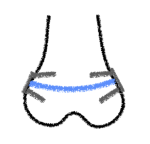 epifisiodesi simmetrica