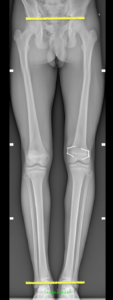 epifisiodesi simmetrica