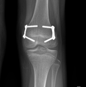 epifisiodesi simmetrica per correggere eterometria