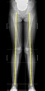 ginocchio valgo radiografie panoramiche