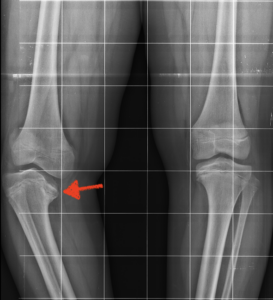 radiografia malattia di blount
