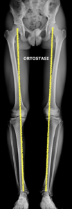 radiografia panoramica ginocchio varo