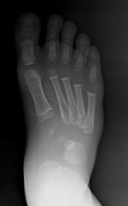 metatarso varo radiografia
