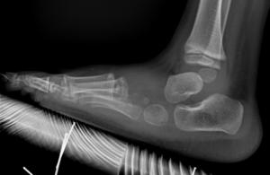 radiografia piede torto