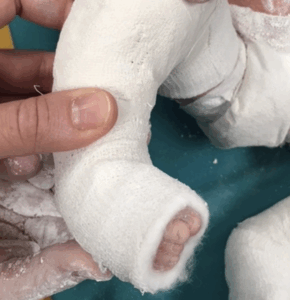 piede torto metodo ponseti