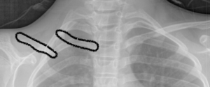 Pseudartrosi congenita di clavicola
