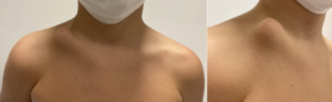 Pseudartrosi congenita di clavicola