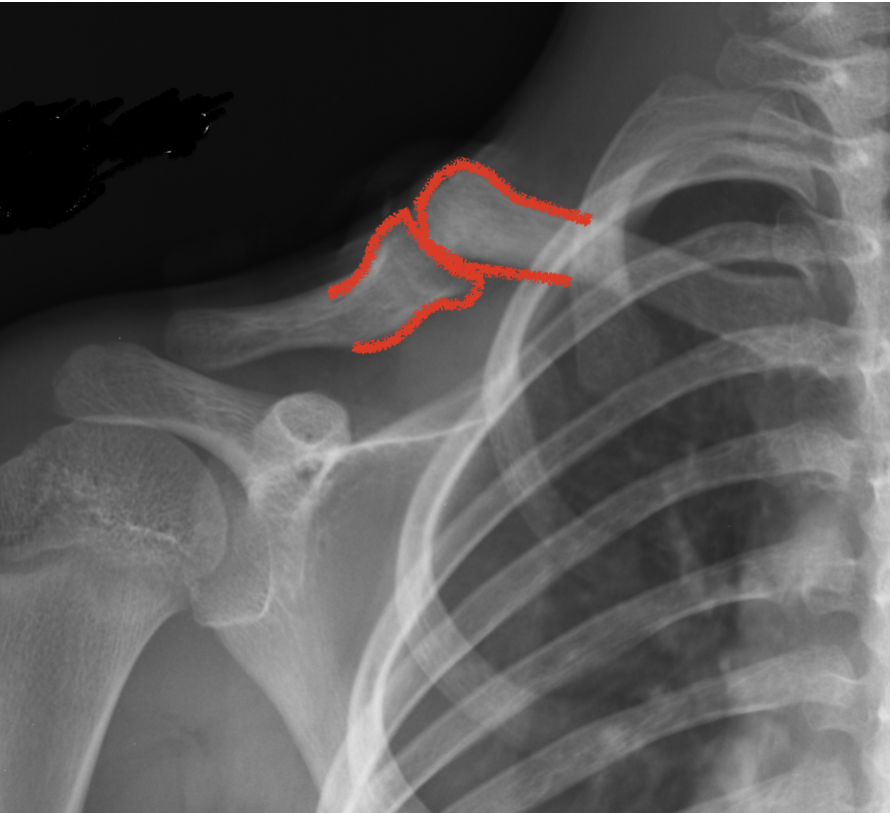 Pseudartrosi congenita di clavicola radiografia