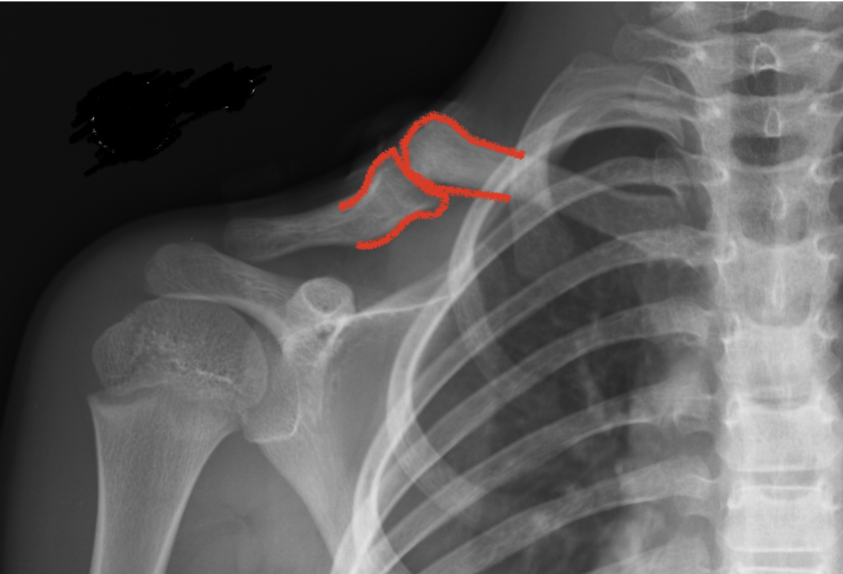 Pseudartrosi congenita di clavicola radiografia