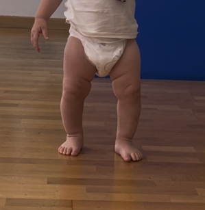ginocchio varo bambino