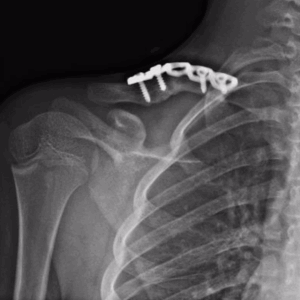 ricostruzione clavicola pseudartrosi
