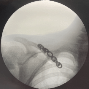 Ricostruzione pseudartrosi clavicola