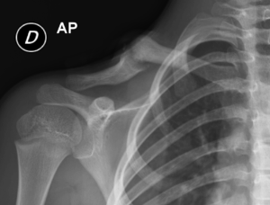 pseudartrosi congenita di clavicola