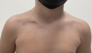 ricostruzione pseudartrosi clavicola
