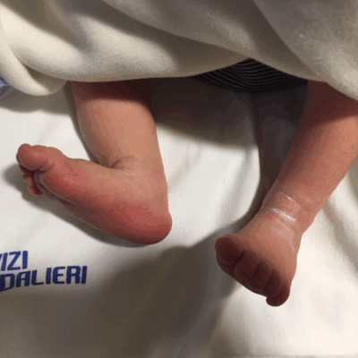 piede talo valgo pronato neonato