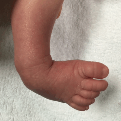 piede torto neonato