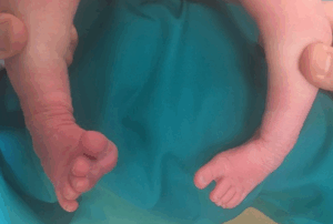 piede torto posizionale neonato