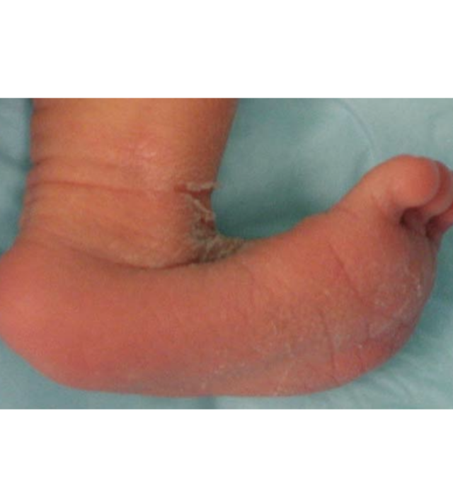 astragalo verticale neonato