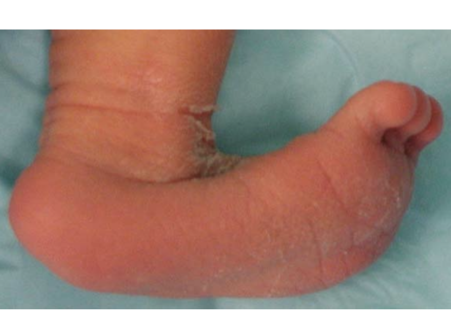 astragalo verticale neonato