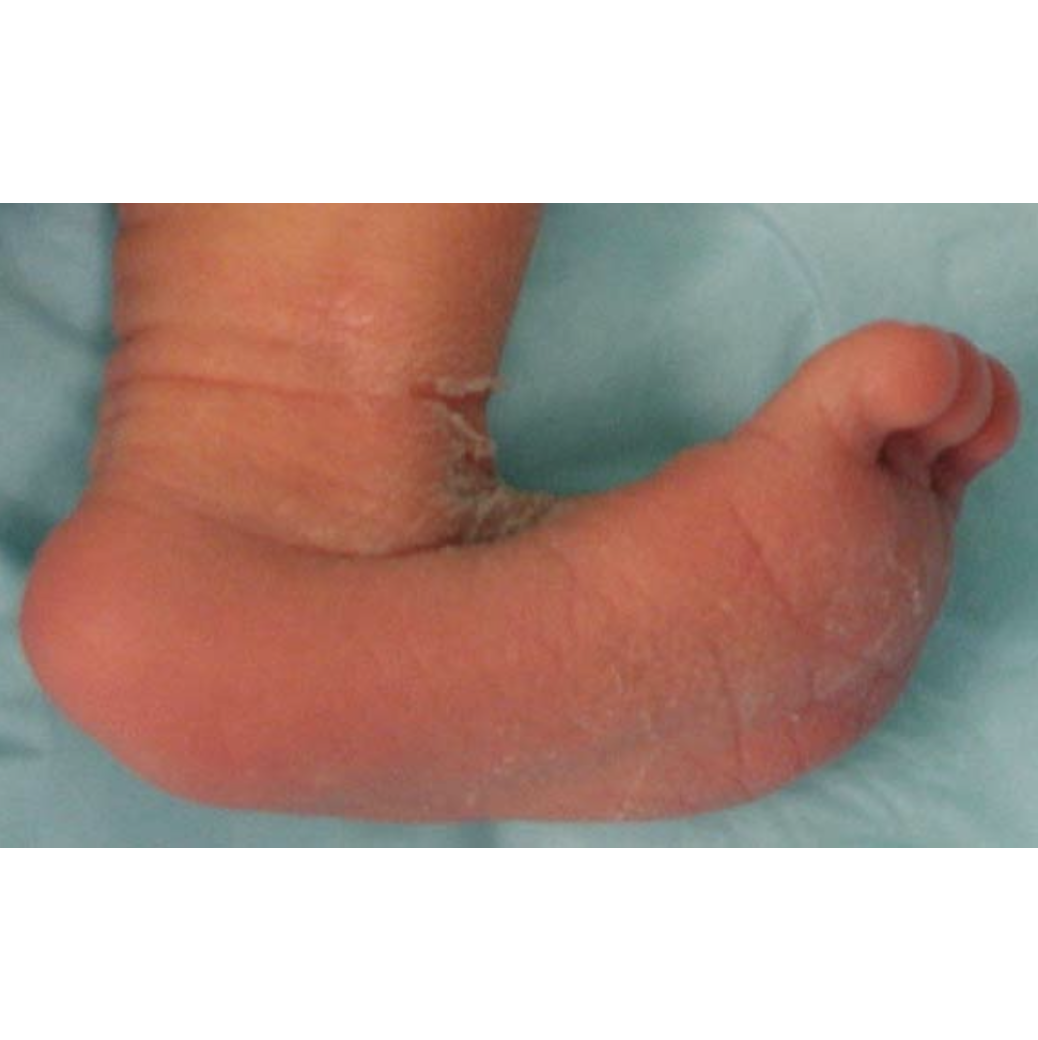 astragalo verticale neonato