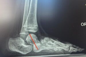 astragalo verticale radiografia