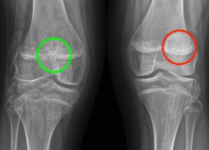instabilità rotulea sindrome di down