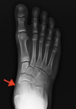 Piede piatto Fig 5A radiografia piede piatto