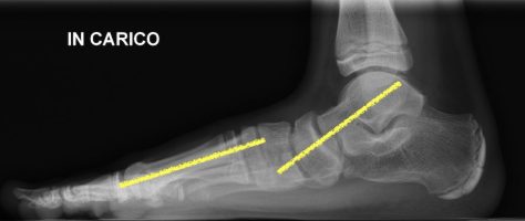 Piede piatto Fig 5B radiografia piede piatto